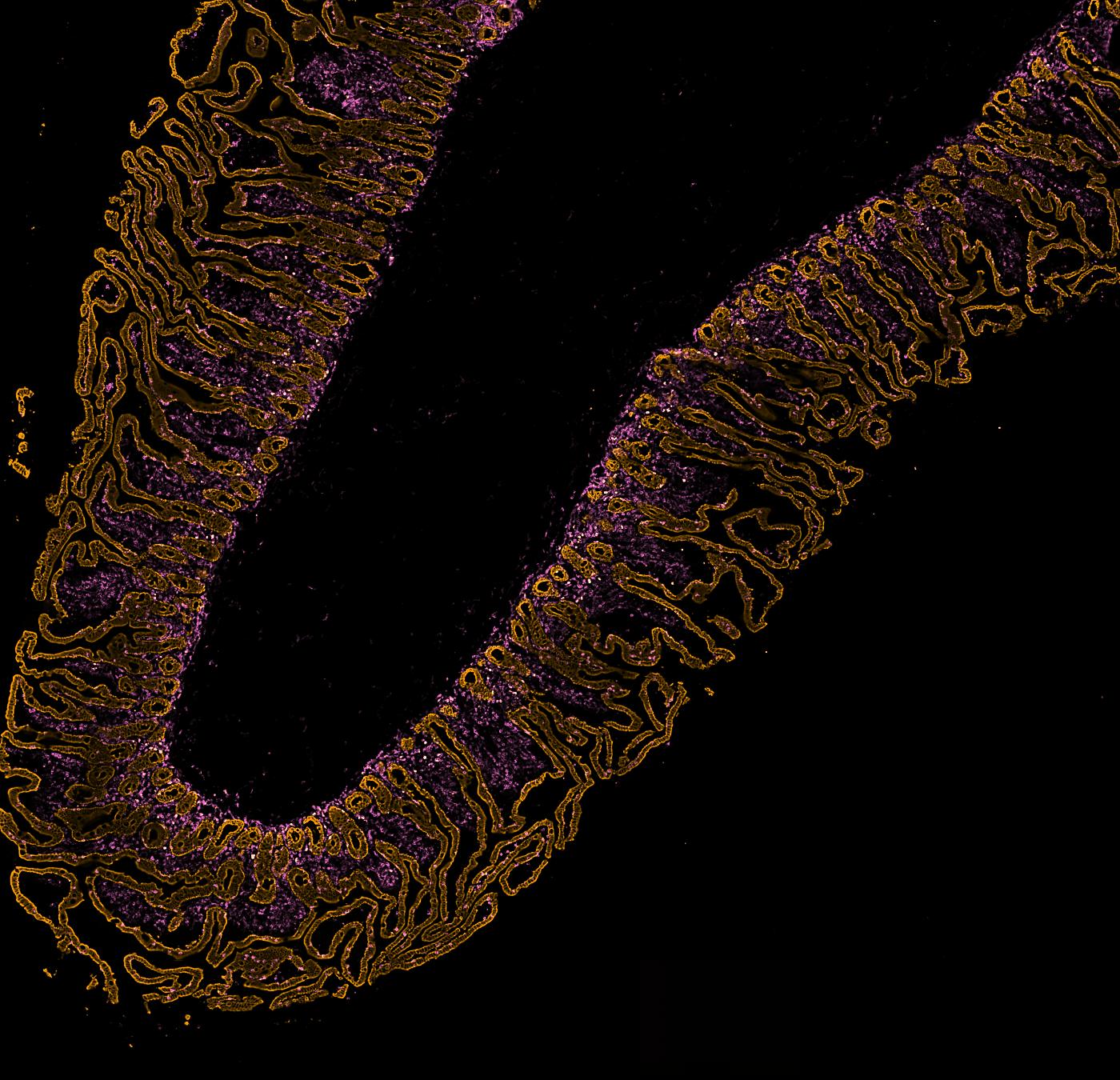 The section with Cytokeratin and CD45 in colour.
