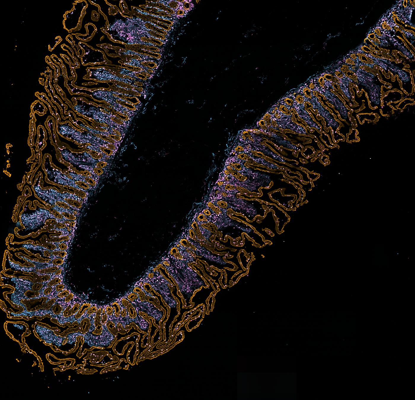 The section with Cytokeratin and Vimentin and CD45 in colour.
