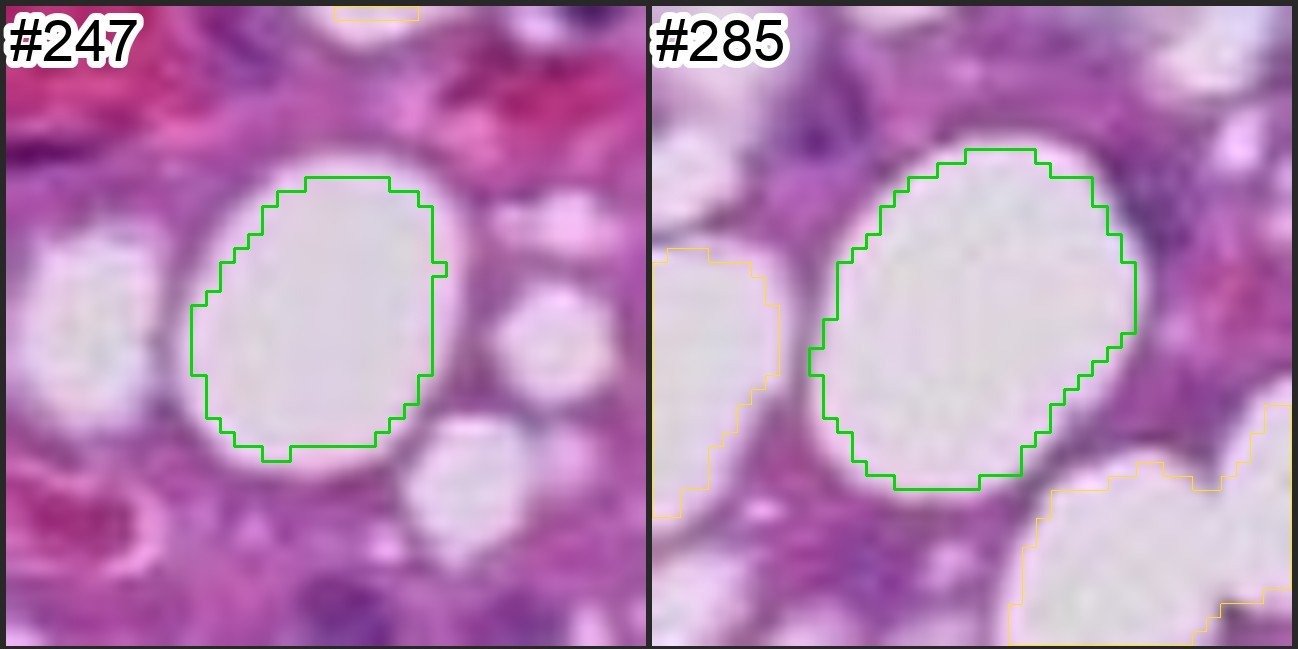 Close-ups of single fat droplets, each with its outline.