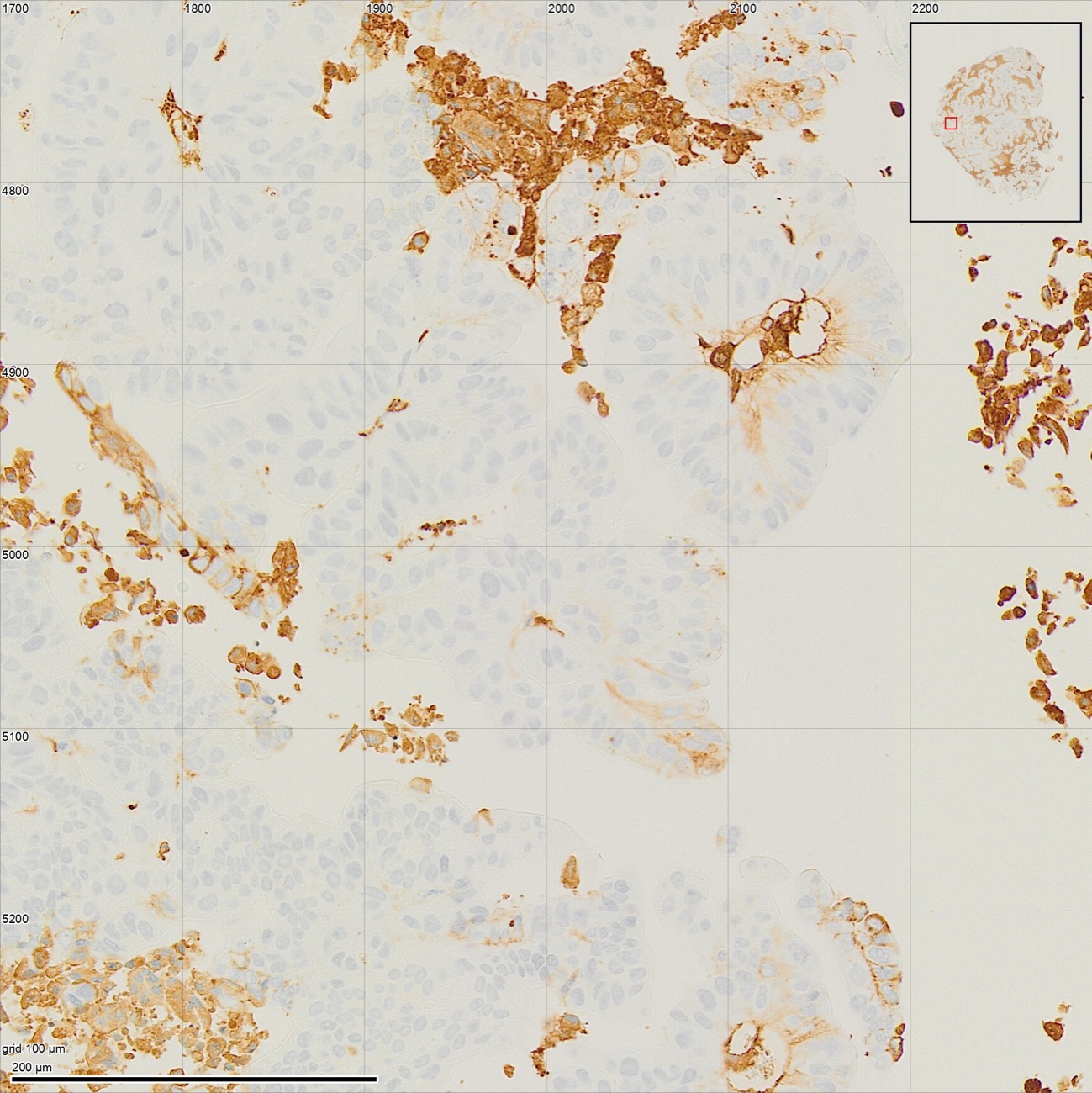 A close-up of the tumour edge with loose brown cells and glass between them, on a 100 µm grid.