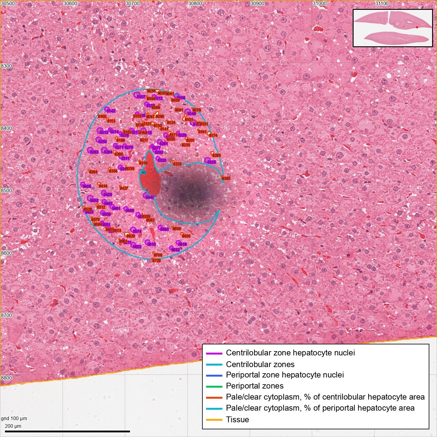 A grey out-of-focus smudge beside a vein, with the zone and its counted nuclei around it.