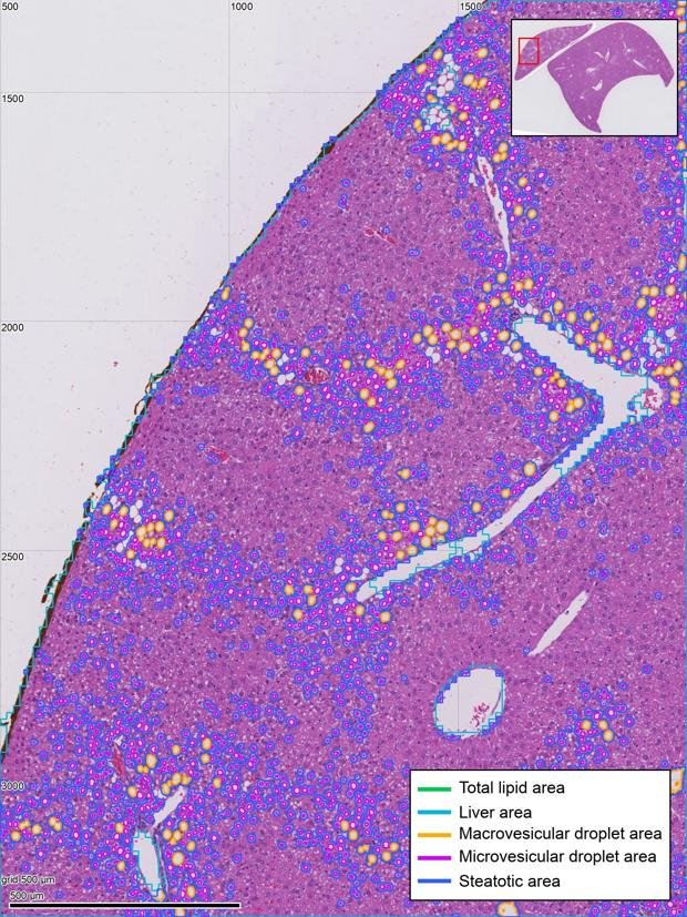 A fatty liver area with dense droplet clusters outlined.