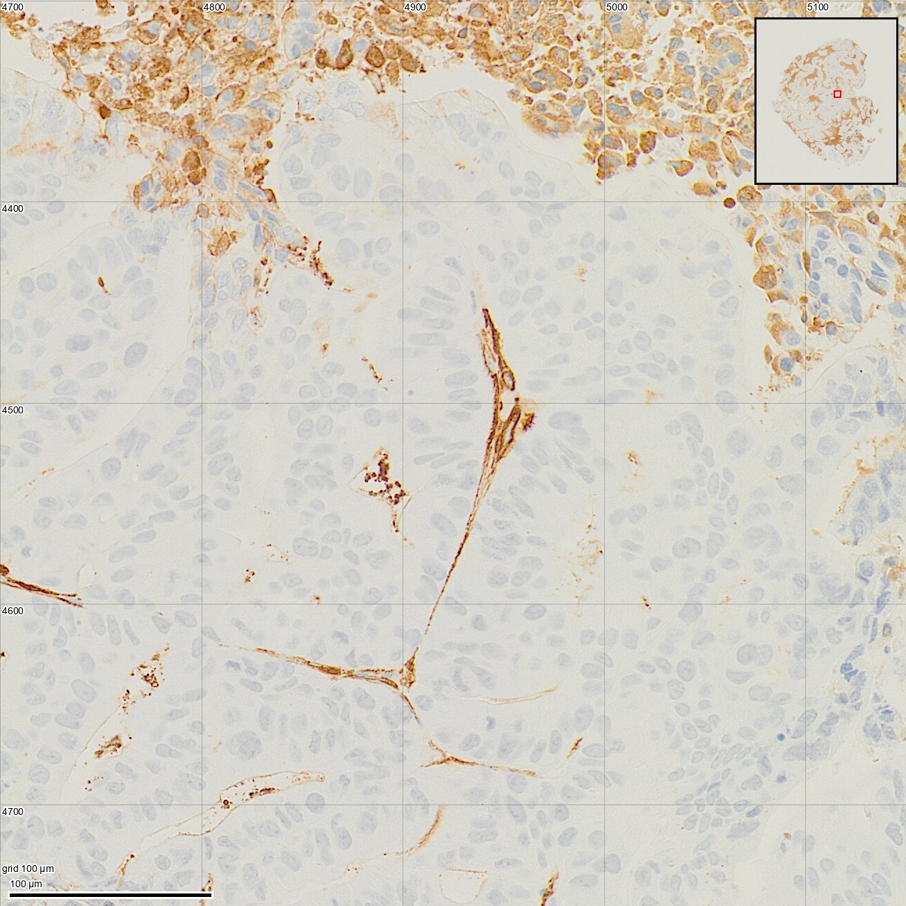 A close-up of tumour with thin brown strands between pale tumour cells, on a 100 µm grid.