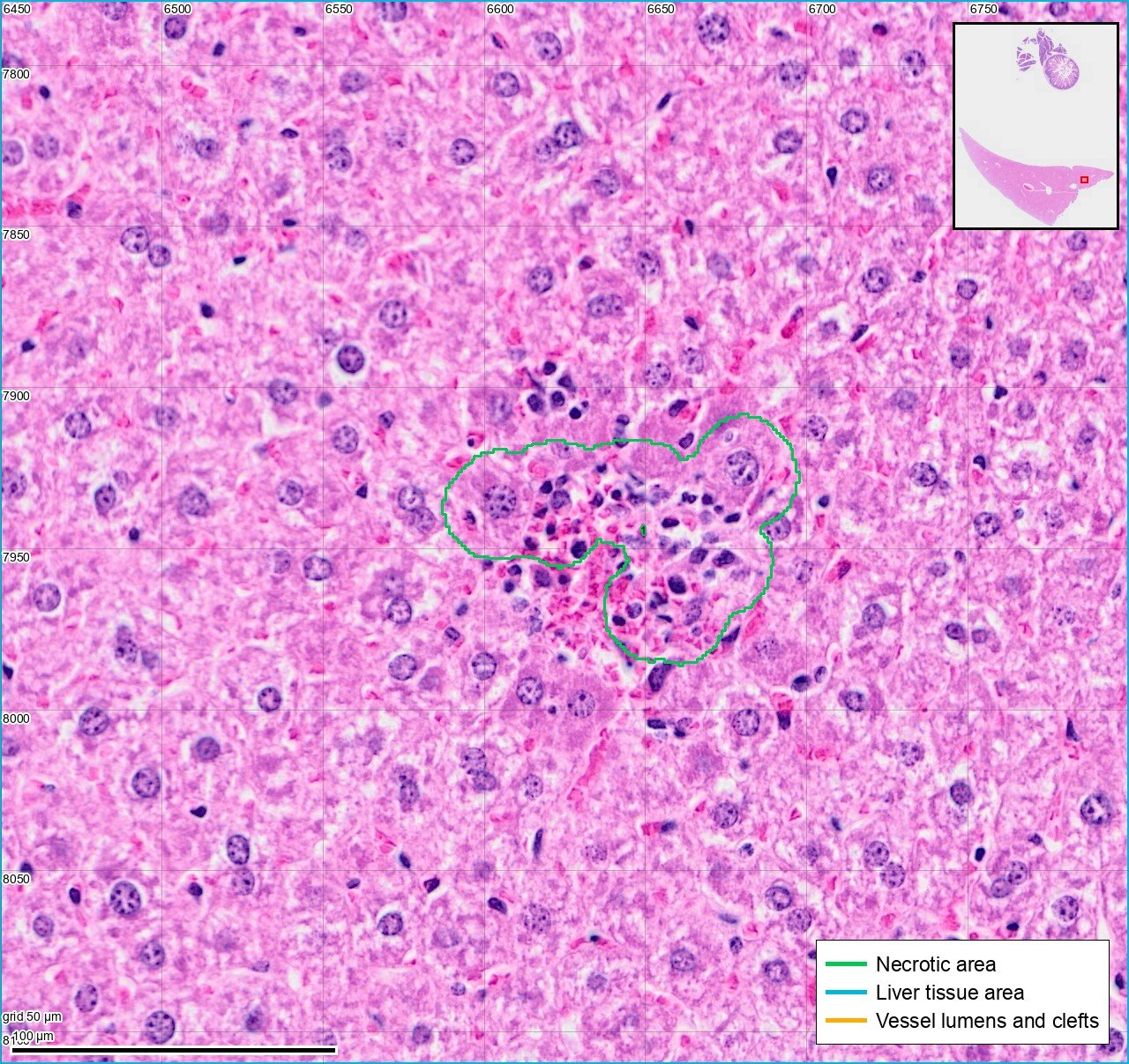 A small focus of necrosis in liver tissue, outlined in green.