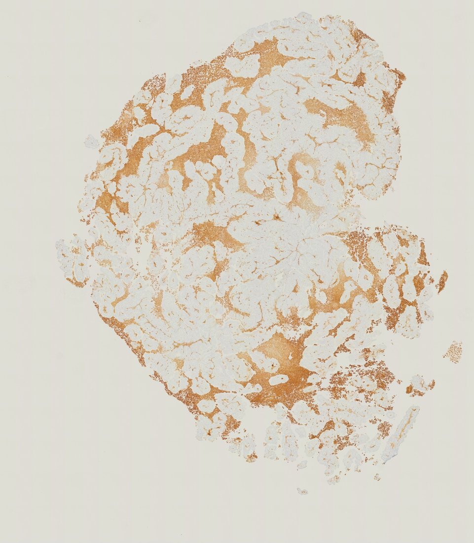 A whole section of a mouse tumour stained brown for α-SMA, between pale tumour lobules.