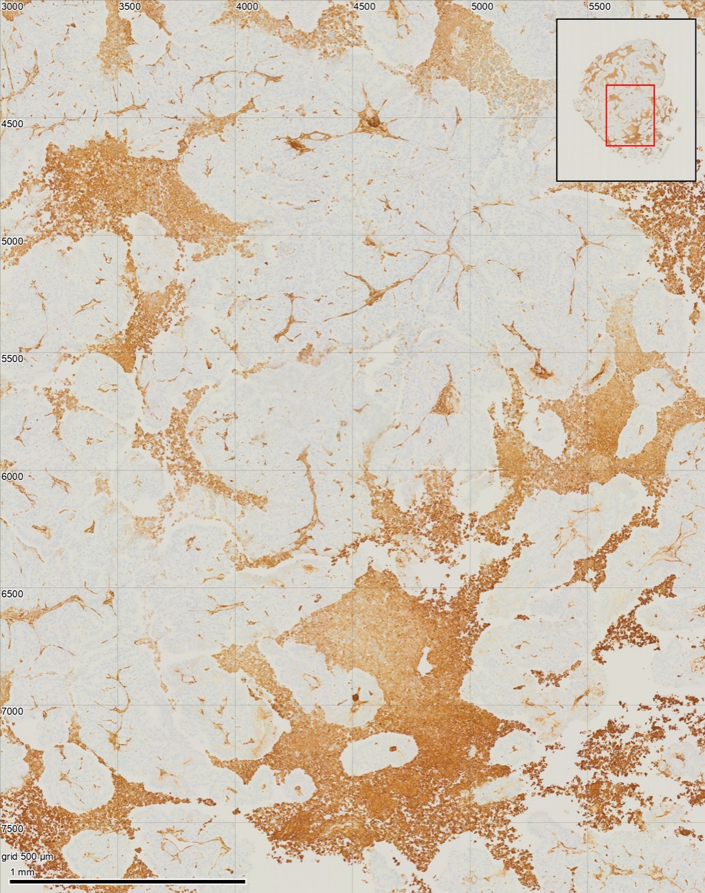 A close view: thin branching brown strands between pale tumour lobules, beside large brown areas of rounded, damaged-looking cells.