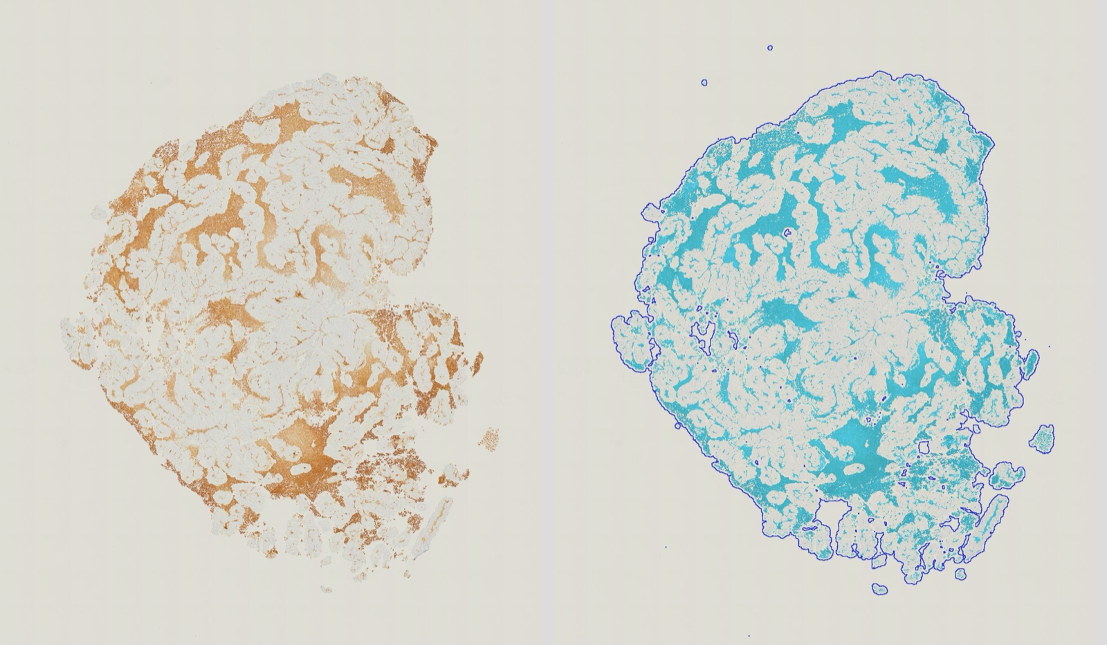A whole mouse tumour section stained brown for α-SMA, and the same section with its tissue outline in dark blue and positive pixels in cyan.